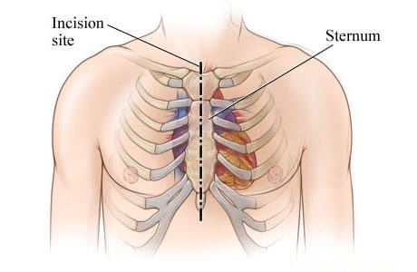 Chest incision site down the middle of the sternum from top to bottom of sternum.