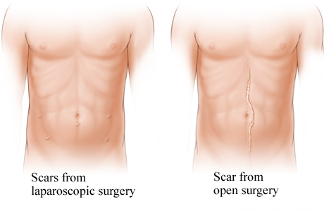 Comparison of laparoscopic surgery scars and open surgery scar