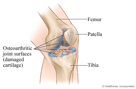 Knee joint with osteoarthritis Knee joint with osteoarthritis