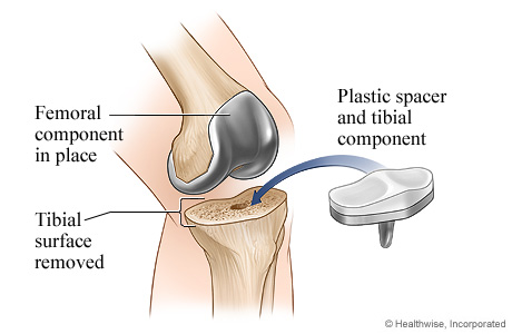 Knee replacement surgery: Tibial component Knee replacement surgery: Tibial component