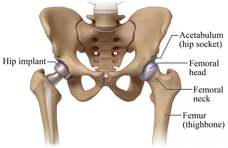 Hip with partial hip implant and normal hip showing the hip socket, femoral head and neck, and femur