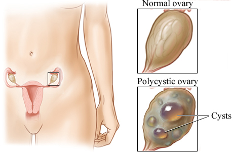 Location of the ovaries with closeup of a normal ovary and a polycystic ovary