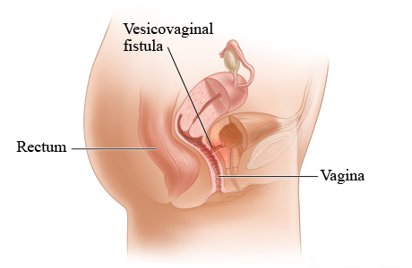 Picture of a vesicovaginal fistula