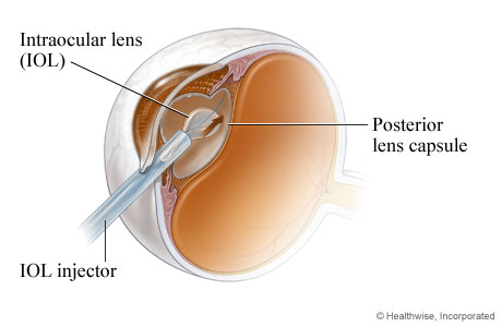 An intraocular lens being placed during cataract surgery An intraocular lens being placed during cataract surgery