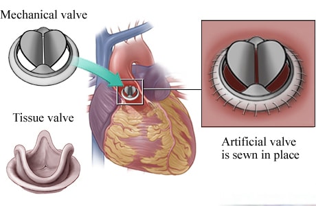 Mechanical valve and tissue valve, showing mechanical valve in heart, with detail of valve sewn in place.