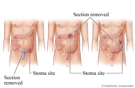 Possible stoma sites Possible stoma sites