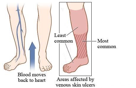 Veins in lower legs, showing areas affected by venous skin ulcers, including most common area from ankle to below the calf and less common areas of foot and calf.