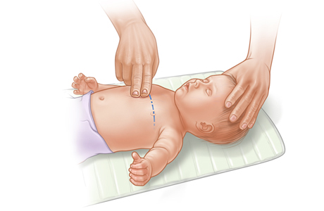 CPR on infant, showing placement of two fingers on breastbone.