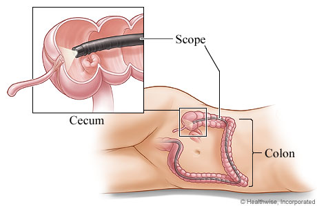 Colonoscope in the colon Colonoscope in the colon