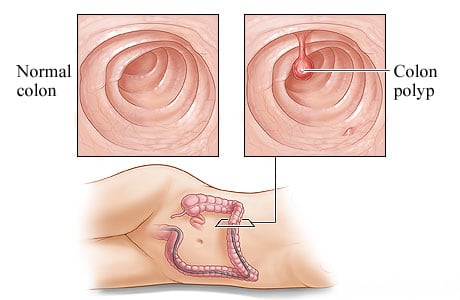 A healthy colon and a colon polyp A healthy colon and a colon polyp