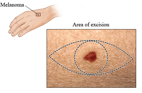 Area of excision for melanoma