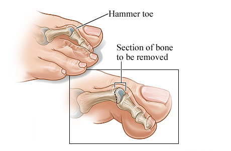 Hammer toe and the section of bone to be removed Hammer toe and the section of bone to be removed