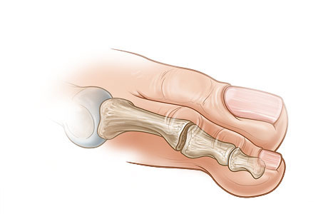 Straightened toe after bone section has been removed Straightened toe after bone section has been removed