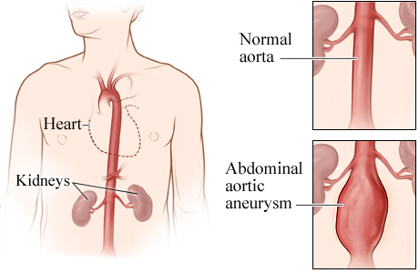A normal aorta and an abdominal aortic aneurysm