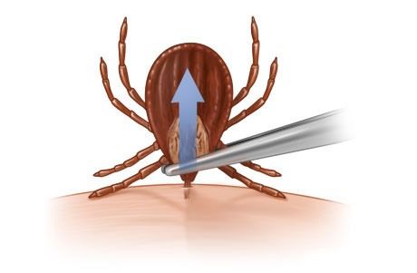 Removing a tick with tweezers.