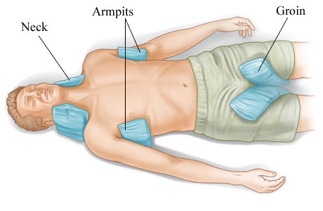 How to cool a victim who has heatstroke