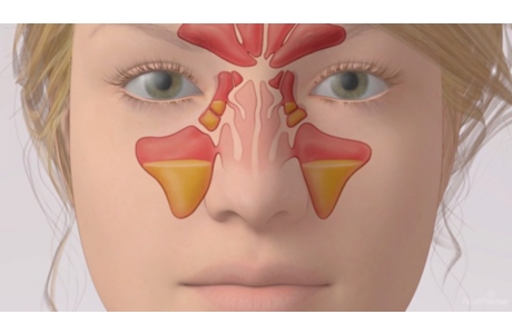 Acute Sinusitis