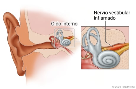 Oído interno, con detalle del nervio vestibular inflamado.