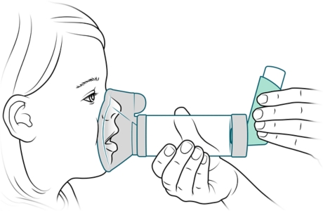 Espaciador con mascarilla bien ajustado sobre la boca y la nariz de un niño.