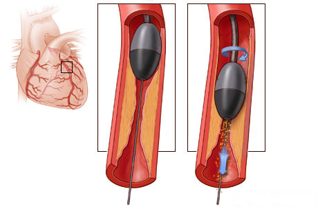 Dispositivo de extracción rotacional eliminando la placa