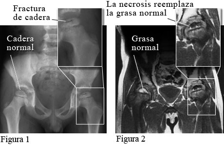 Imagen de la enfermedad de Legg-Calve-Perthes