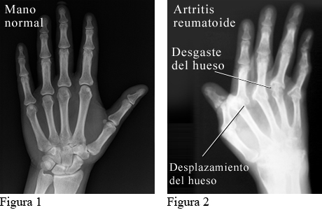 Radiografía que muestra artritis reumatoide en las manos