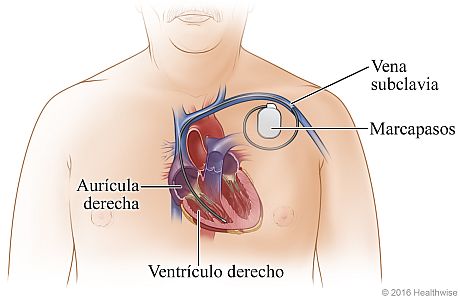 Ubicación del marcapasos en la parte superior izquierda del pecho, que muestra su derivación a través de la vena subclavia y dentro del ventrículo derecho