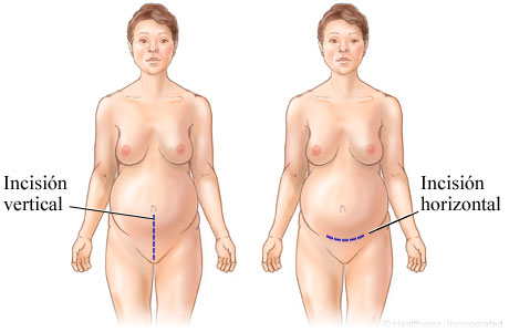 Imagen de incisiones de una cesárea