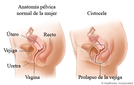 Cistocele