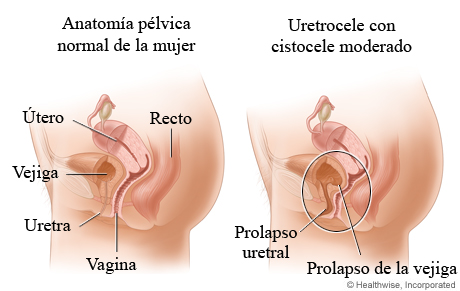 Uretrocele