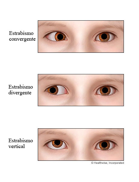 Tipos de estrabismo