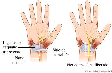 Cirugía abierta de liberación del túnel carpiano