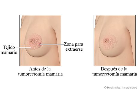Antes y después de la tumorectomía mamaria