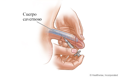 Imagen de una inyección de medicamento en el pene