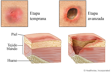 Etapa inicial y etapa avanzada de lesiones por presión.