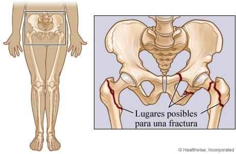 Posibles lugares de fractura pélvica y de cadera