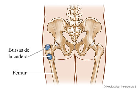 Bursitis de la cadera