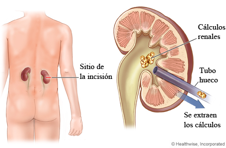 Cómo se extraen los cálculos renales con la nefrolitotomía