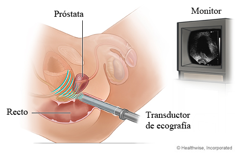 Ecografía transrectal