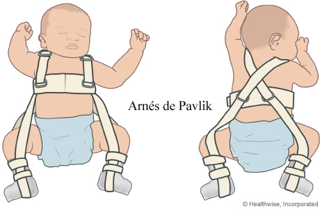 Arnés de Pavlik en un bebé