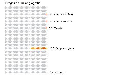 De cada 1,000 personas que se someten a una angiografía, menos de 20 tendrán sangrado grave, 1 o 2 personas morirán, 1 o 2 personas tendrán un ataque cerebral y 1 o 2 personas tendrán un ataque cardíaco.