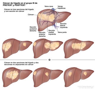 Cáncer de hígado en el grupo III de PRETEXT y POSTTEXT. En el dibujo se observan 7 hígados que se dividen con líneas punteadas en 4 secciones verticales de casi el mismo tamaño. En el primer hígado, el cáncer se encuentra en 3 secciones de la izquierda y se señalan la vena cava detrás del hígado, las venas hepáticas, la vena porta, la sección posterior derecha, la sección anterior derecha, la sección medial izquierda y la sección lateral izquierda del hígado. En el segundo hígado, el cáncer se encuentra en las 2 secciones de la izquierda y en la sección extrema derecha. En el tercer hígado, el cáncer se encuentra en la sección extrema izquierda y en las 2 secciones de la derecha. En el cuarto hígado, el cáncer se encuentra en 3 secciones de la derecha. En el quinto hígado, el cáncer se encuentra en las 2 secciones del medio. En el sexto hígado, el cáncer se encuentra en la sección extrema izquierda y en la segunda sección desde la derecha. En el séptimo hígado, el cáncer se encuentra en la sección extrema derecha y en la segunda sección desde la izquierda.