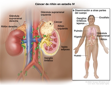 Cáncer de riñón en estadio IV. El dibujo se divide en dos recuadros: a la izquierda se muestra cáncer que se diseminó más allá de la capa de tejido adiposo que rodea el riñón izquierdo y que llega hasta la glándula suprarrenal izquierda encima del riñón izquierdo; también se muestran muchos ganglios linfáticos, la glándula suprarrenal derecha y el riñón derecho. En el recuadro de la derecha se observa el cuerpo completo de un adulto y se señalan otras partes a las que el cáncer de riñón se puede diseminar: el encéfalo, un pulmón, el hígado, una glándula suprarrenal, un hueso del muslo o ganglios linfáticos lejanos en el cuello.
