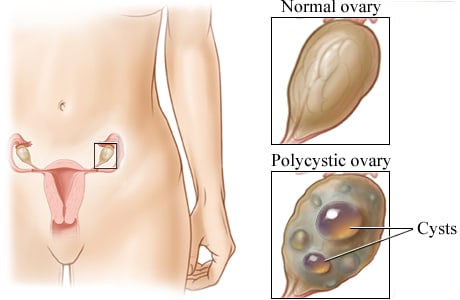 Location of the ovaries with closeup of a normal ovary and a polycystic ovary