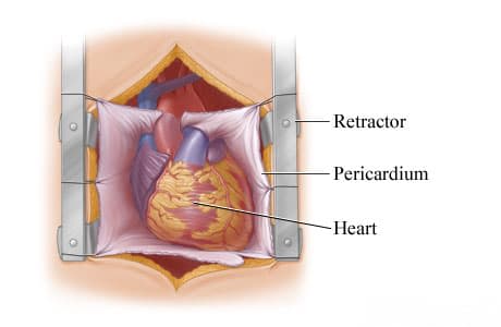 Retractor exposes heart and pericardium.