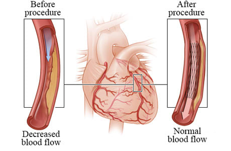 Decreased blood flow caused by narrowed artery before angioplasty compared to normal blood flow after angioplasty.