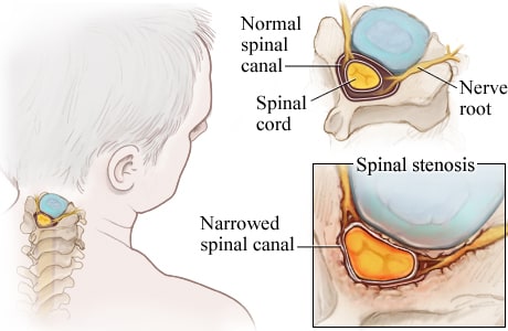 Cross section of normal spinal canal compared to narrowed canal from cervical spinal stenosis.