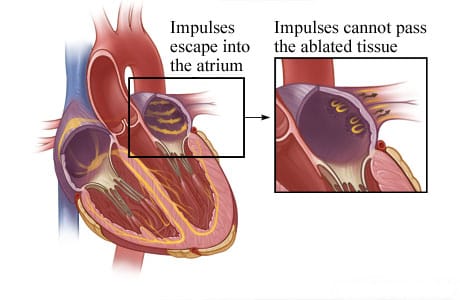 How scar tissue from ablation stops electrical impulses.