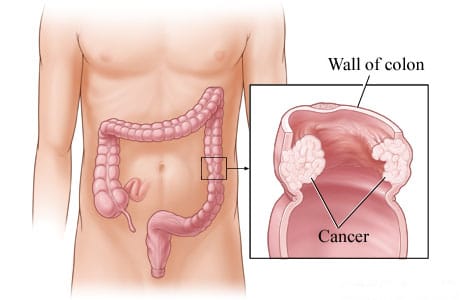 Cancer in the wall of the descending colon
