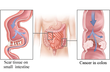 Obstructions in the small and large intestines.